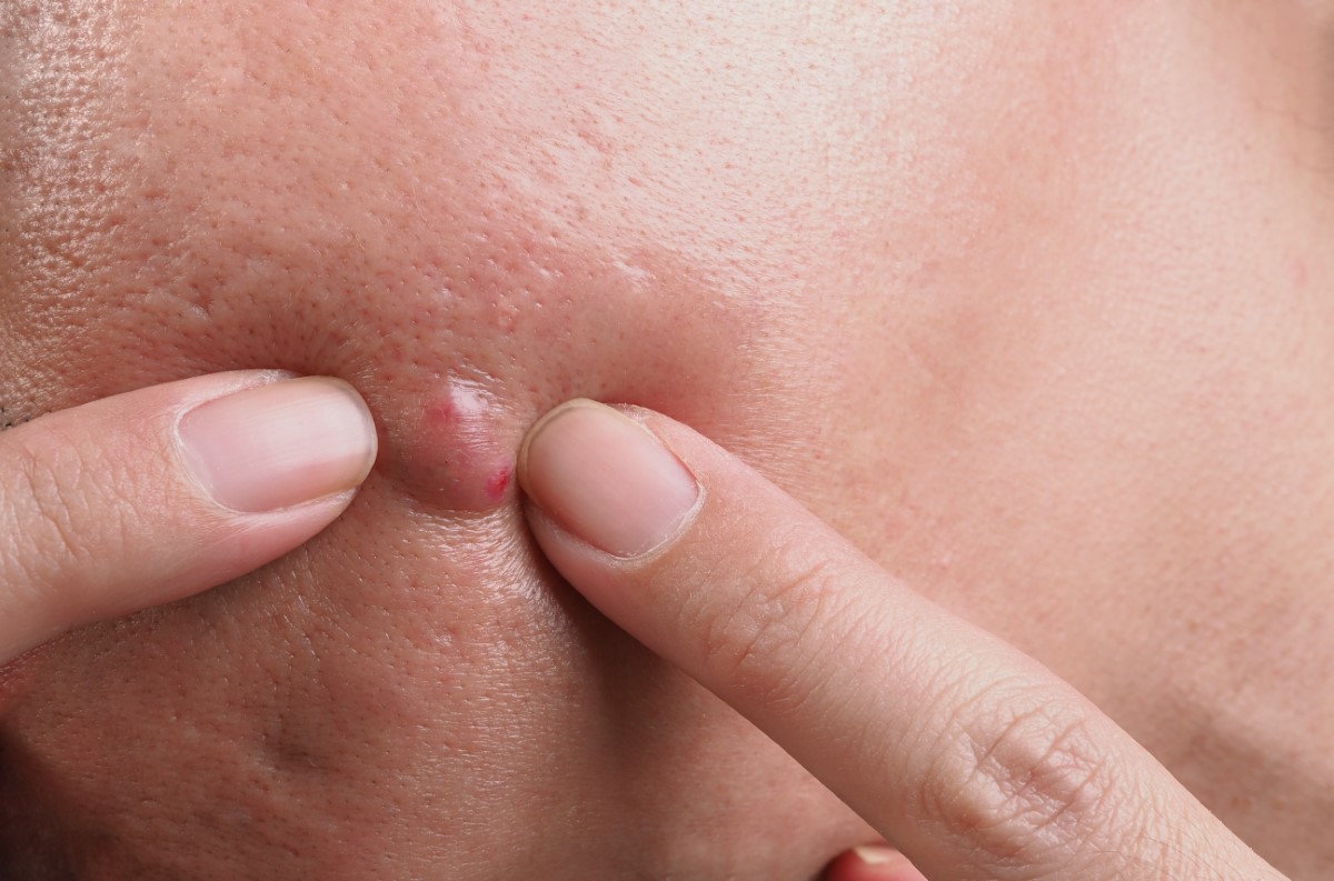 Comment faire mûrir un bouton douloureux ?