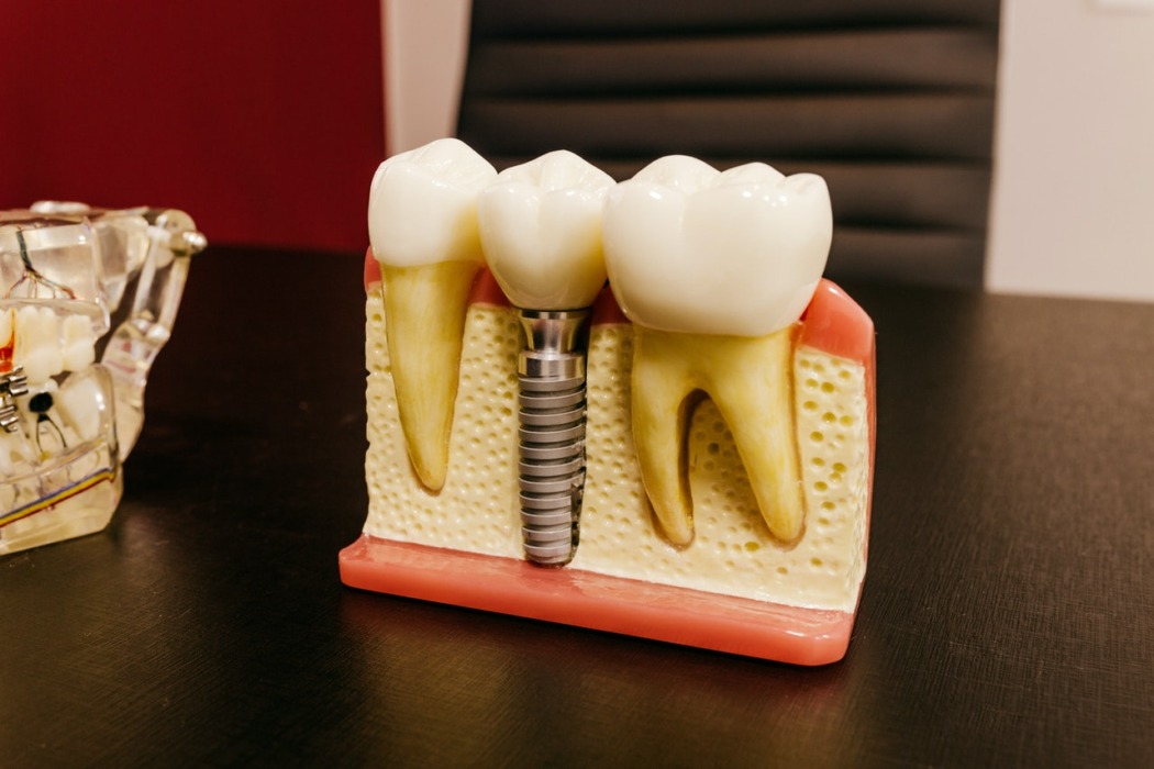 implant dentaire