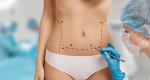 indications Abdominoplastie