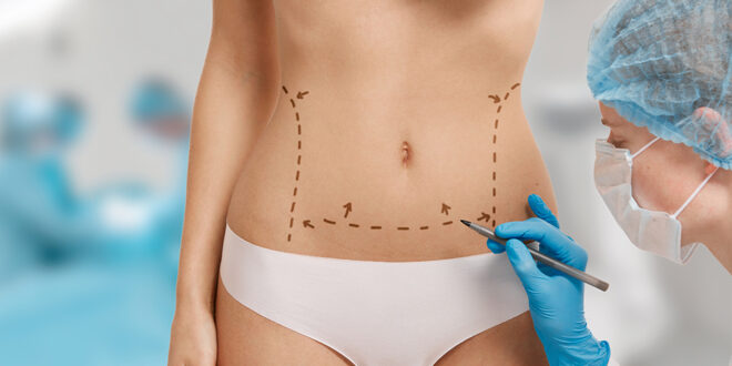 indications Abdominoplastie