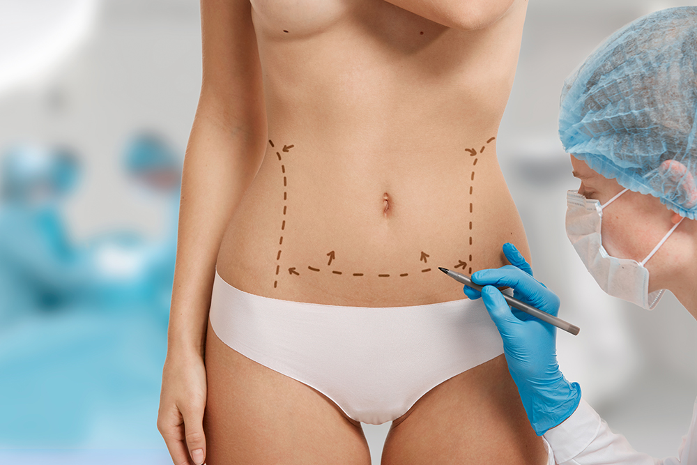 indications Abdominoplastie