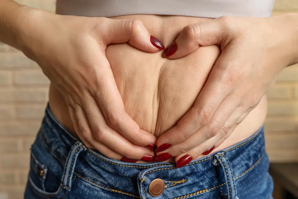 objectifs Abdominoplastie